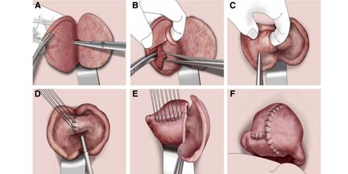 Adenomyomectomy
