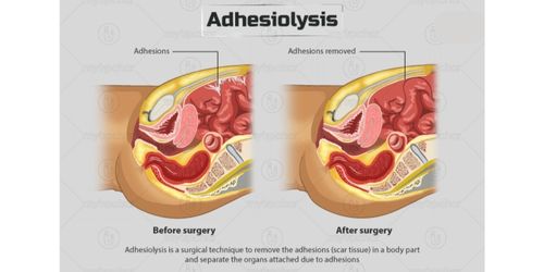 Adhesiolysis