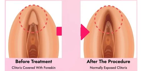 Clitoral Hood Reduction