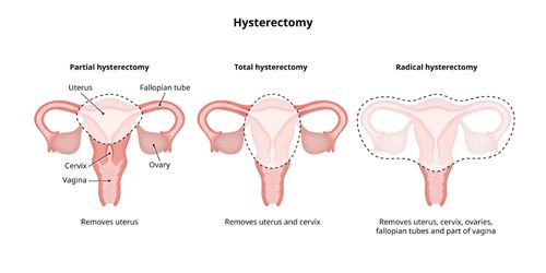 Hysterectomy