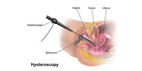Diagnostic Hysteroscopy