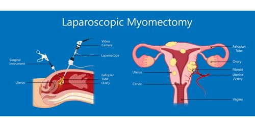 Hysteroscopic Myomectomy