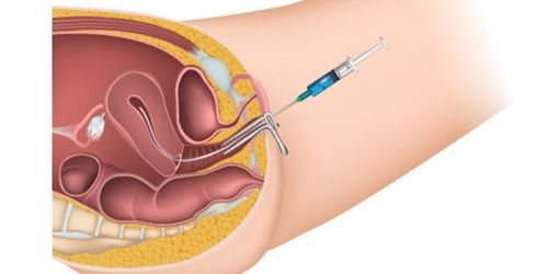 IUI