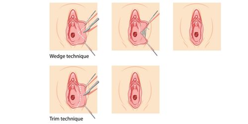 Labiaplasty