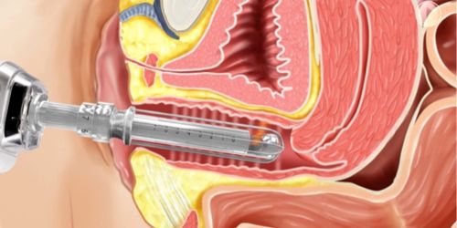 Lesser Vaginal Rejuvenation