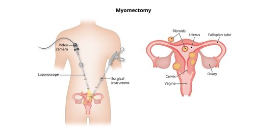 Myomectomy