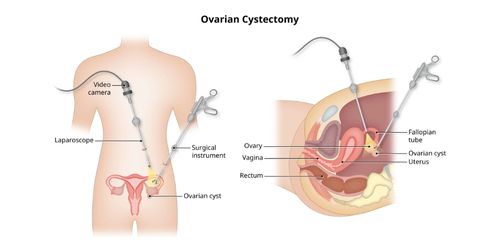 Ovarian Cystectomy