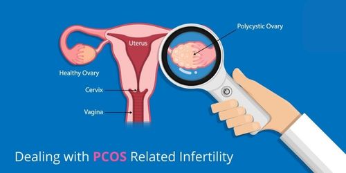 PCOS Treatment