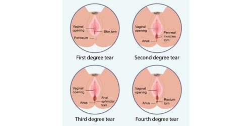 Perineal Reconstruction
