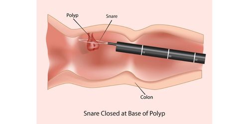 Polypectomy