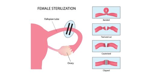Fallopian tube illustration