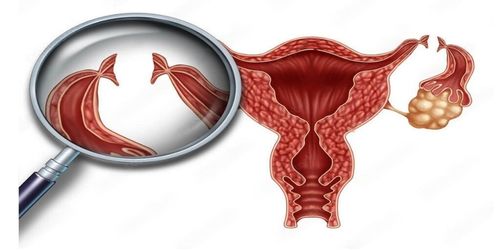 Tubectomy