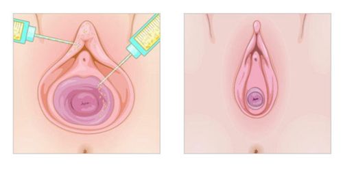 Vaginal PRP & Exosomes