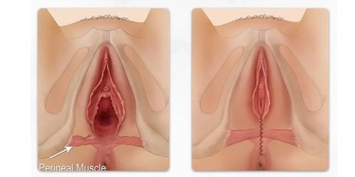Vaginoplasty