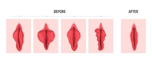 Vulval Rejuvenation