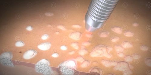 Vulval Warts Removal